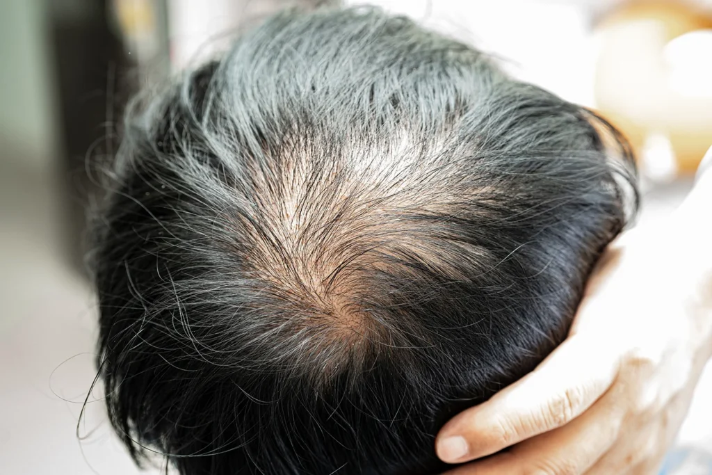 bald-in-the-middle